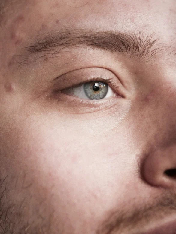 Blemish-Prone Skin
